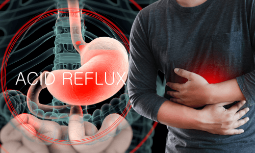Foods to Avoid with Acid Reflux: Your Ultimate Guide to Relief
